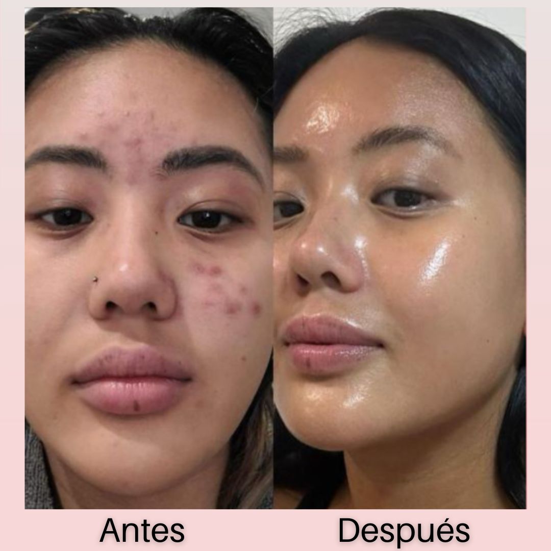 🌟  Acné, Manchas o Arrugas? Luce una piel radiante ¡desde casa!